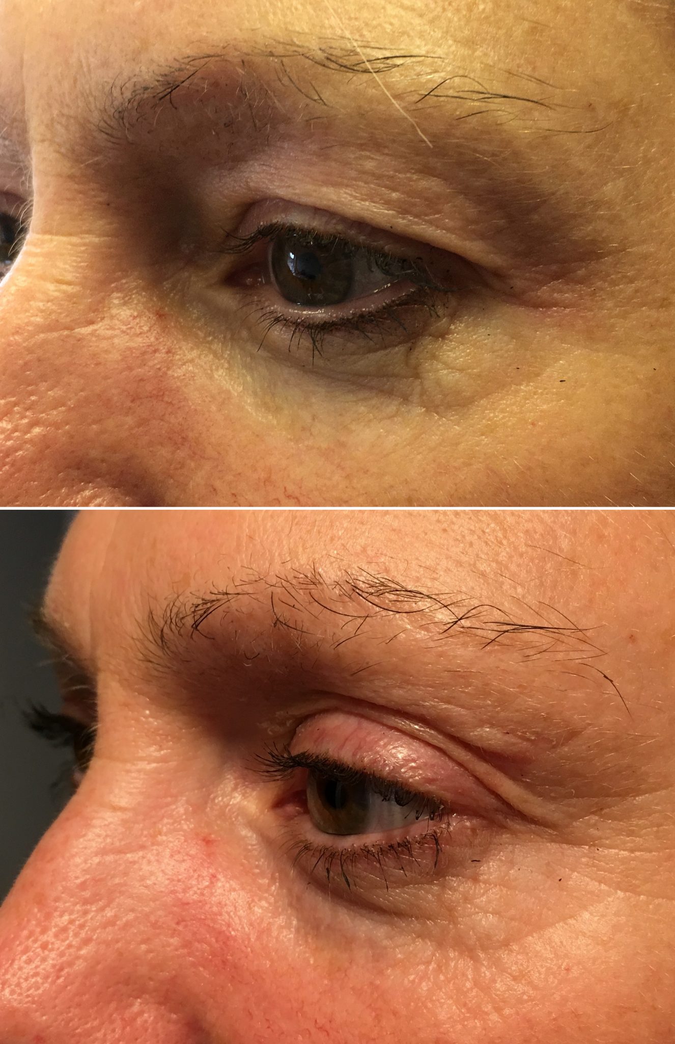 Plasma Pen Fibroblast with Chequers Hair and Beauty, Leadenhall Market
